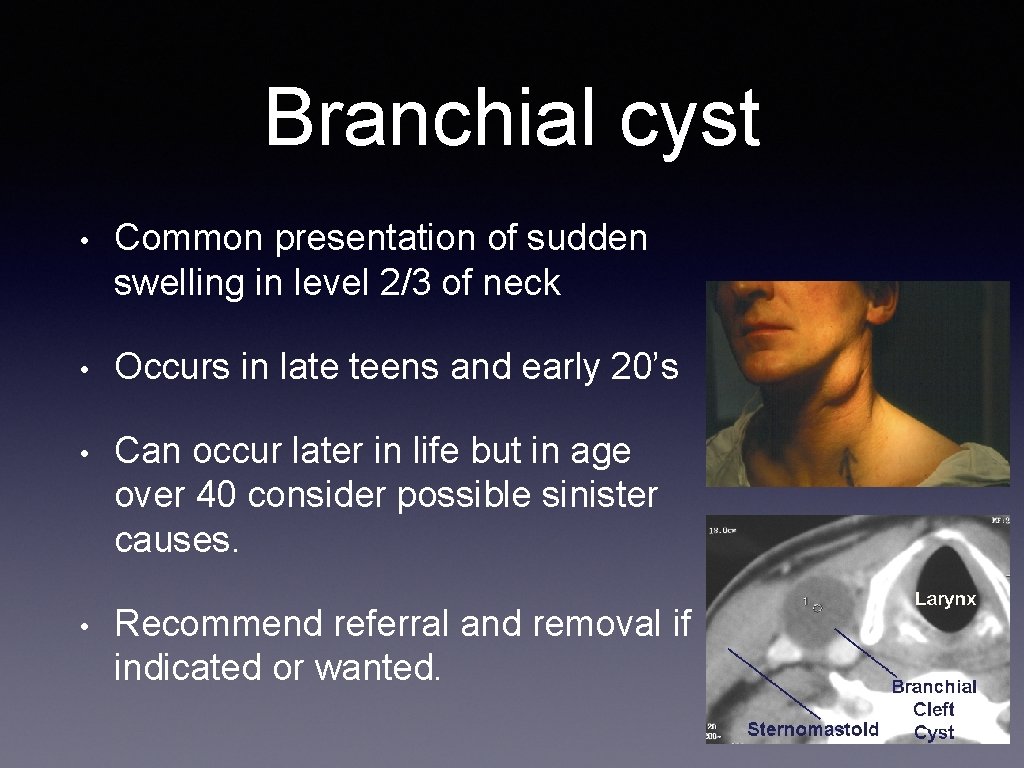 Branchial cyst • Common presentation of sudden swelling in level 2/3 of neck •