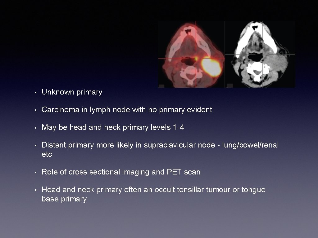  • Unknown primary • Carcinoma in lymph node with no primary evident •