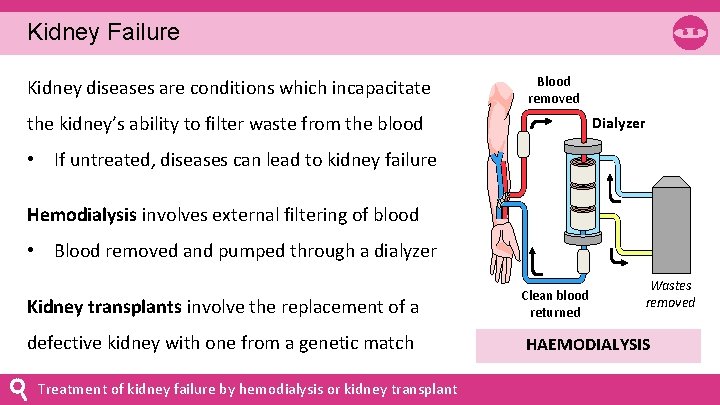 Kidney Failure Kidney diseases are conditions which incapacitate Blood removed the kidney’s ability to