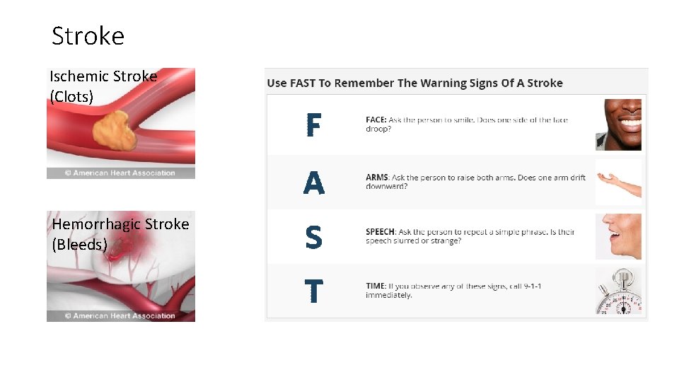 Stroke Ischemic Stroke (Clots) Hemorrhagic Stroke (Bleeds) Stroke Ischemic Stroke (Clots) Hemorrhagic Stroke (Bleeds)
