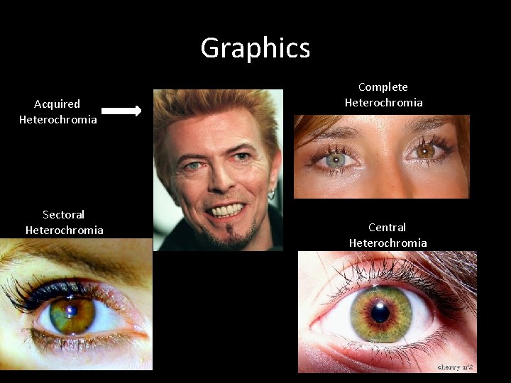 Graphics Acquired Heterochromia Sectoral Heterochromia Complete Heterochromia Central Heterochromia 