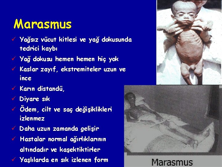 Marasmus ü Yağsız vücut kitlesi ve yağ dokusunda tedrici kaybı ü Yağ dokusu hemen Marasmus ü Yağsız vücut kitlesi ve yağ dokusunda tedrici kaybı ü Yağ dokusu hemen