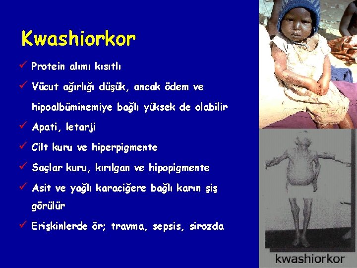Kwashiorkor ü Protein alımı kısıtlı ü Vücut ağırlığı düşük, ancak ödem ve hipoalbüminemiye bağlı Kwashiorkor ü Protein alımı kısıtlı ü Vücut ağırlığı düşük, ancak ödem ve hipoalbüminemiye bağlı