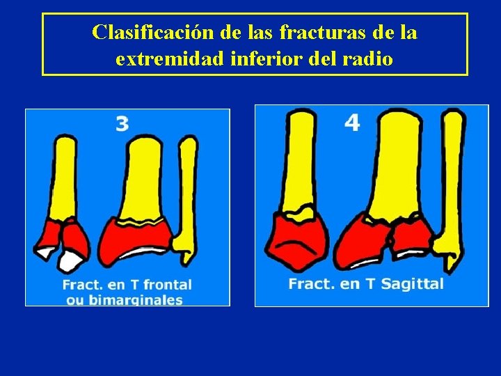 Clasificación de las fracturas de la extremidad inferior del radio Clasificación de las fracturas de la extremidad inferior del radio