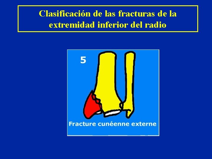 Clasificación de las fracturas de la extremidad inferior del radio Clasificación de las fracturas de la extremidad inferior del radio