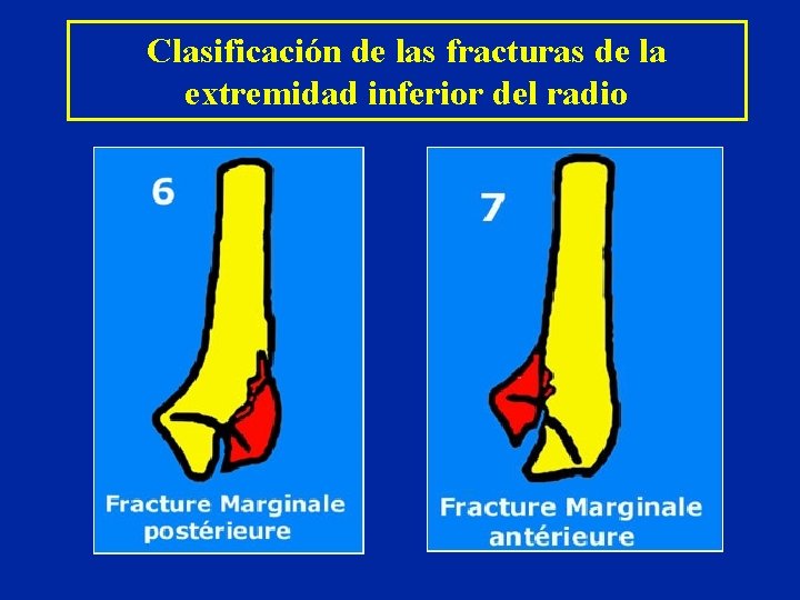 Clasificación de las fracturas de la extremidad inferior del radio Clasificación de las fracturas de la extremidad inferior del radio
