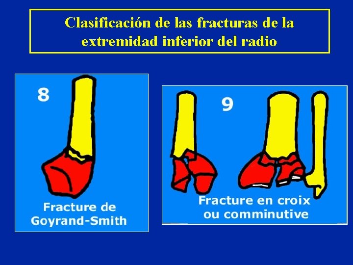 Clasificación de las fracturas de la extremidad inferior del radio Clasificación de las fracturas de la extremidad inferior del radio