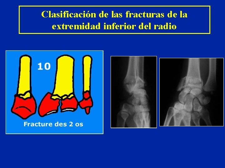 Clasificación de las fracturas de la extremidad inferior del radio Clasificación de las fracturas de la extremidad inferior del radio