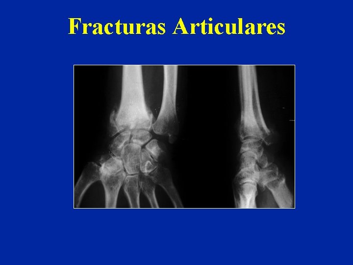 Fracturas Articulares Fracturas Articulares