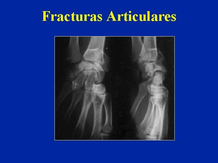 Fracturas Articulares Fracturas Articulares