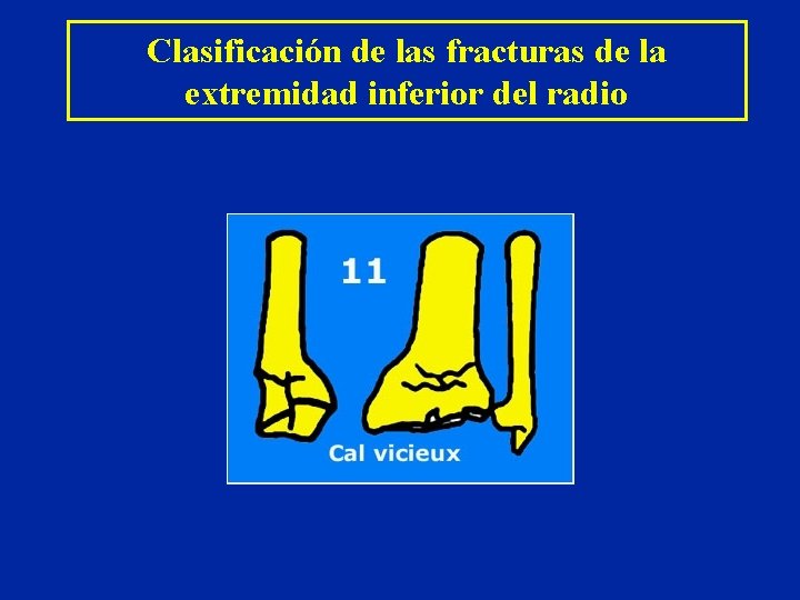 Clasificación de las fracturas de la extremidad inferior del radio Clasificación de las fracturas de la extremidad inferior del radio