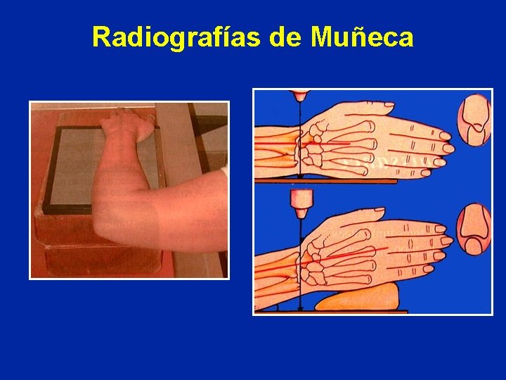 Radiografías de Muñeca Radiografías de Muñeca