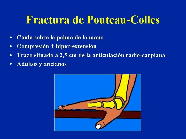 Fractura de Pouteau-Colles • • Caída sobre la palma de la mano Compresión + Fractura de Pouteau-Colles • • Caída sobre la palma de la mano Compresión +