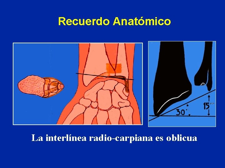 Recuerdo Anatómico La interlínea radio-carpiana es oblicua Recuerdo Anatómico La interlínea radio-carpiana es oblicua