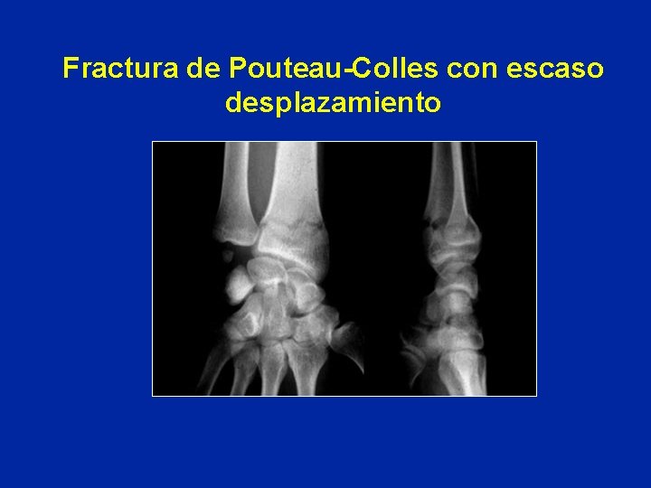 Fractura de Pouteau-Colles con escaso desplazamiento Fractura de Pouteau-Colles con escaso desplazamiento