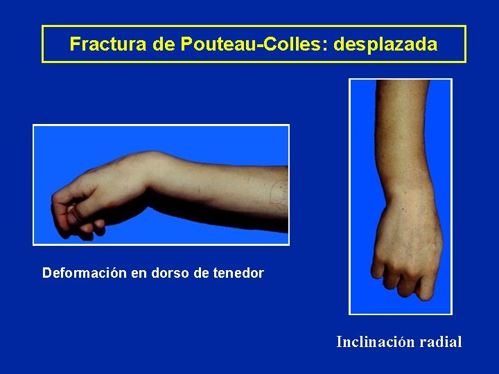 Fractura de Pouteau-Colles: desplazada Deformación en dorso de tenedor Inclinación radial Fractura de Pouteau-Colles: desplazada Deformación en dorso de tenedor Inclinación radial