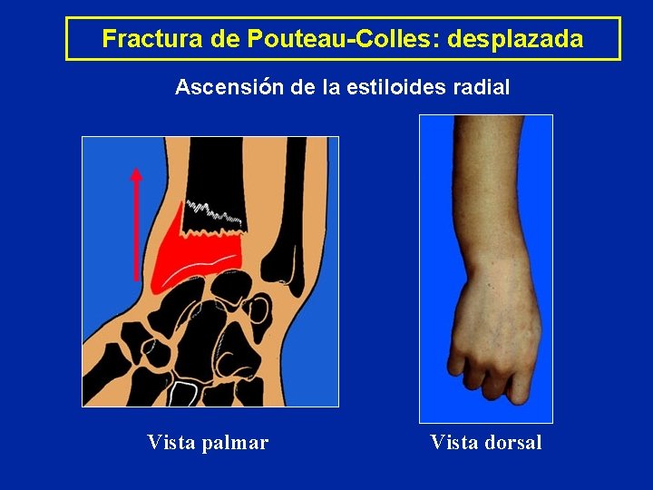 Fractura de Pouteau-Colles: desplazada Ascensión de la estiloides radial Vista palmar Vista dorsal Fractura de Pouteau-Colles: desplazada Ascensión de la estiloides radial Vista palmar Vista dorsal