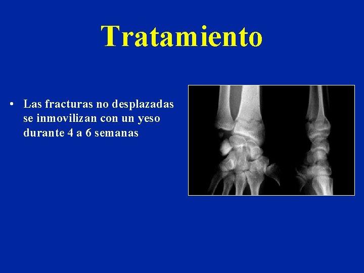 Tratamiento • Las fracturas no desplazadas se inmovilizan con un yeso durante 4 a Tratamiento • Las fracturas no desplazadas se inmovilizan con un yeso durante 4 a