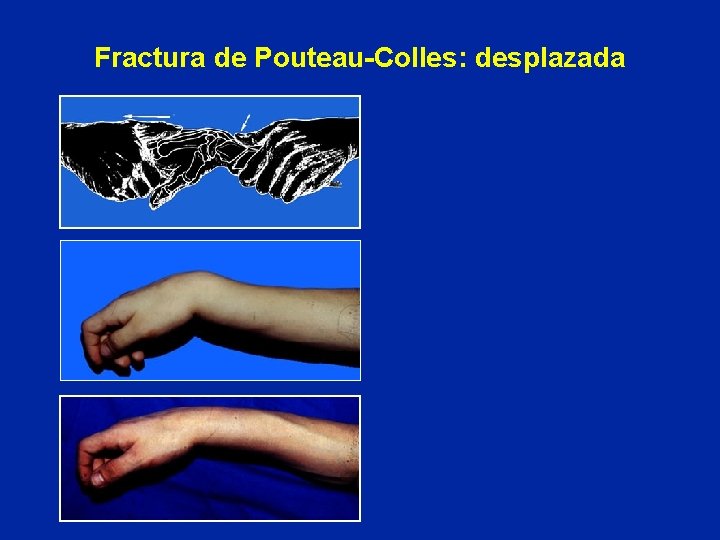 Fractura de Pouteau-Colles: desplazada Fractura de Pouteau-Colles: desplazada
