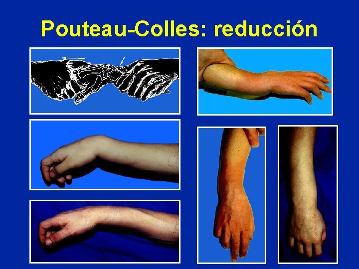 Pouteau-Colles: reducción Pouteau-Colles: reducción