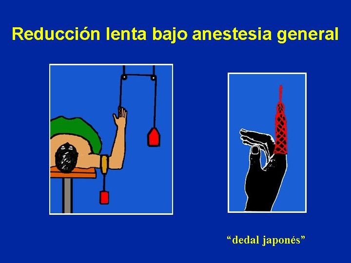 Reducción lenta bajo anestesia general “dedal japonés” Reducción lenta bajo anestesia general “dedal japonés”