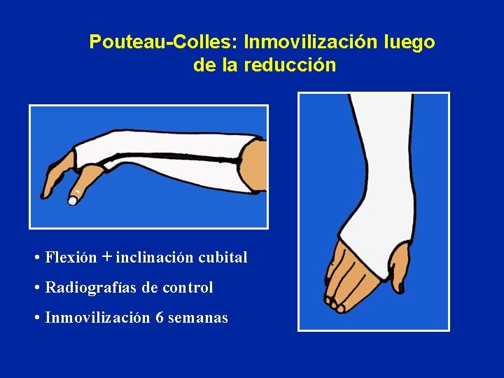Pouteau-Colles: Inmovilización luego de la reducción • Flexión + inclinación cubital • Radiografías de Pouteau-Colles: Inmovilización luego de la reducción • Flexión + inclinación cubital • Radiografías de
