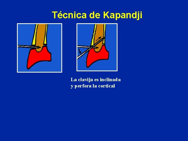 Técnica de Kapandji La clavija es inclinada y perfora la cortical Técnica de Kapandji La clavija es inclinada y perfora la cortical