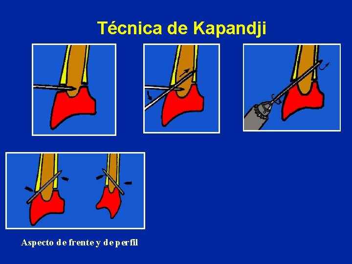 Técnica de Kapandji Aspecto de frente y de perfil Técnica de Kapandji Aspecto de frente y de perfil