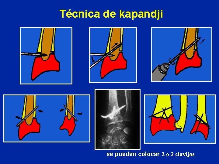 Técnica de kapandji se pueden colocar 2 o 3 clavijas Técnica de kapandji se pueden colocar 2 o 3 clavijas