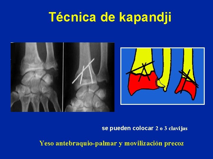 Técnica de kapandji se pueden colocar 2 o 3 clavijas Yeso antebraquio-palmar y movilización Técnica de kapandji se pueden colocar 2 o 3 clavijas Yeso antebraquio-palmar y movilización