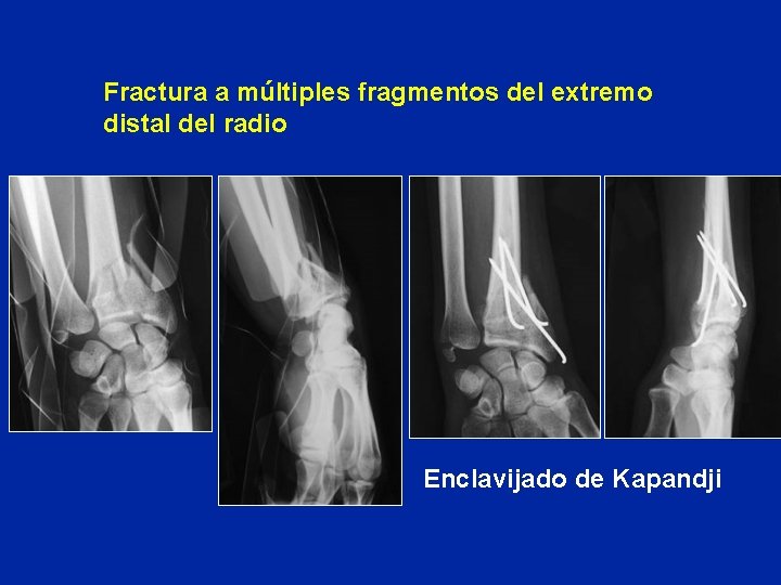 Fractura a múltiples fragmentos del extremo distal del radio Enclavijado de Kapandji Fractura a múltiples fragmentos del extremo distal del radio Enclavijado de Kapandji