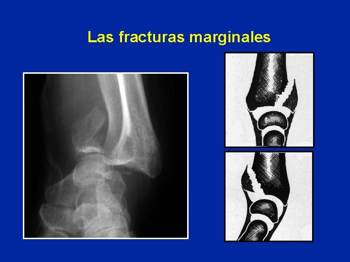 Las fracturas marginales Las fracturas marginales
