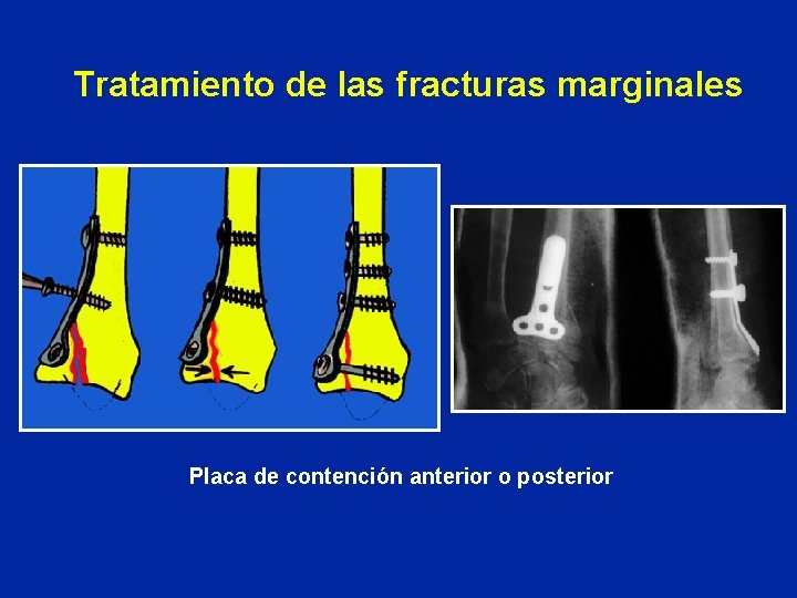Tratamiento de las fracturas marginales Placa de contención anterior o posterior Tratamiento de las fracturas marginales Placa de contención anterior o posterior