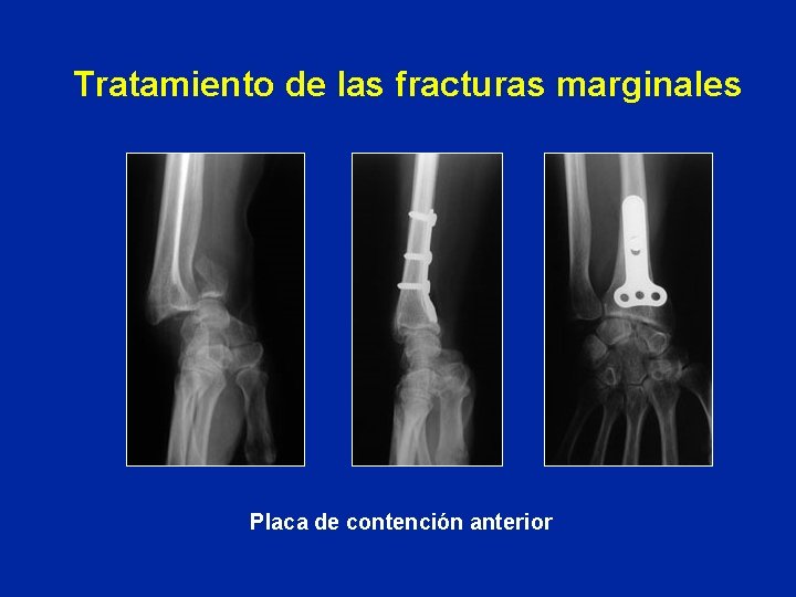 Tratamiento de las fracturas marginales Placa de contención anterior Tratamiento de las fracturas marginales Placa de contención anterior