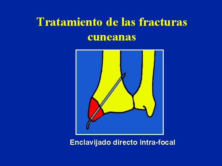 Tratamiento de las fracturas cuneanas Enclavijado directo intra-focal Tratamiento de las fracturas cuneanas Enclavijado directo intra-focal