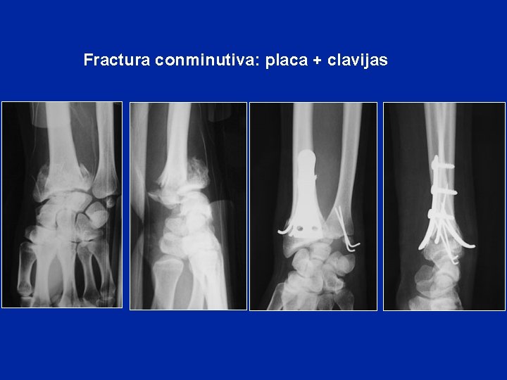 Fractura conminutiva: placa + clavijas Fractura conminutiva: placa + clavijas