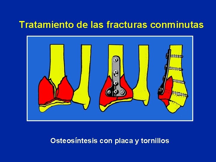 Tratamiento de las fracturas conminutas Osteosíntesis con placa y tornillos Tratamiento de las fracturas conminutas Osteosíntesis con placa y tornillos