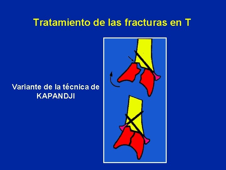 Tratamiento de las fracturas en T Variante de la técnica de KAPANDJI Tratamiento de las fracturas en T Variante de la técnica de KAPANDJI