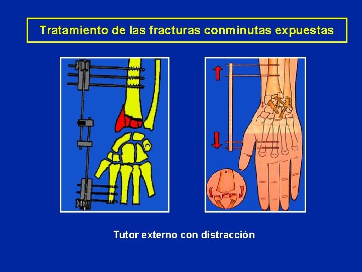 Tratamiento de las fracturas conminutas expuestas Tutor externo con distracción Tratamiento de las fracturas conminutas expuestas Tutor externo con distracción