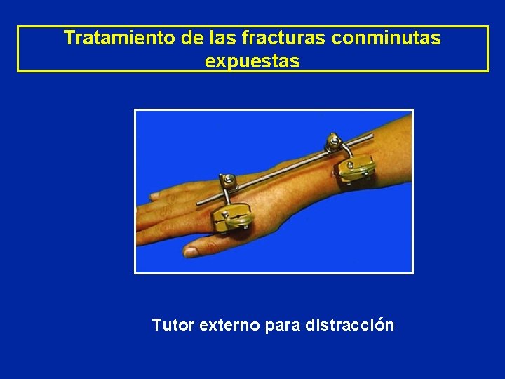 Tratamiento de las fracturas conminutas expuestas Tutor externo para distracción Tratamiento de las fracturas conminutas expuestas Tutor externo para distracción