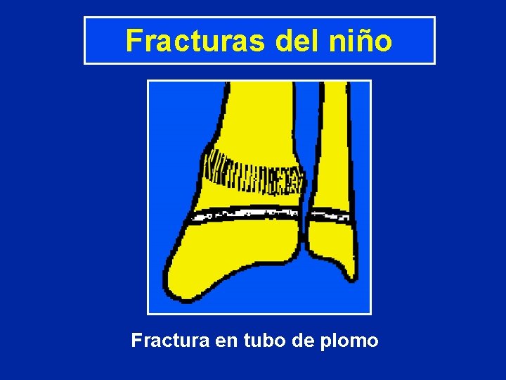Fracturas del niño Fractura en tubo de plomo Fracturas del niño Fractura en tubo de plomo