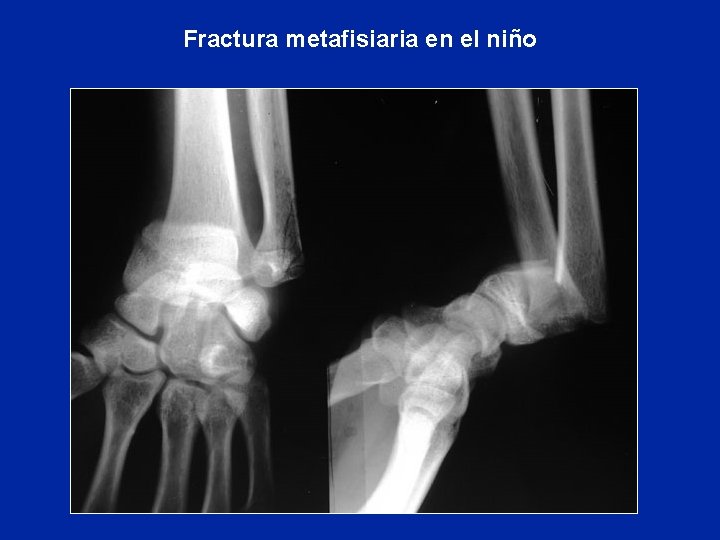 Fractura metafisiaria en el niño Fractura metafisiaria en el niño