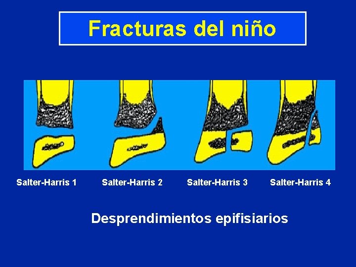 Fracturas del niño Salter-Harris 1 Salter-Harris 2 Salter-Harris 3 Salter-Harris 4 Desprendimientos epifisiarios Fracturas del niño Salter-Harris 1 Salter-Harris 2 Salter-Harris 3 Salter-Harris 4 Desprendimientos epifisiarios