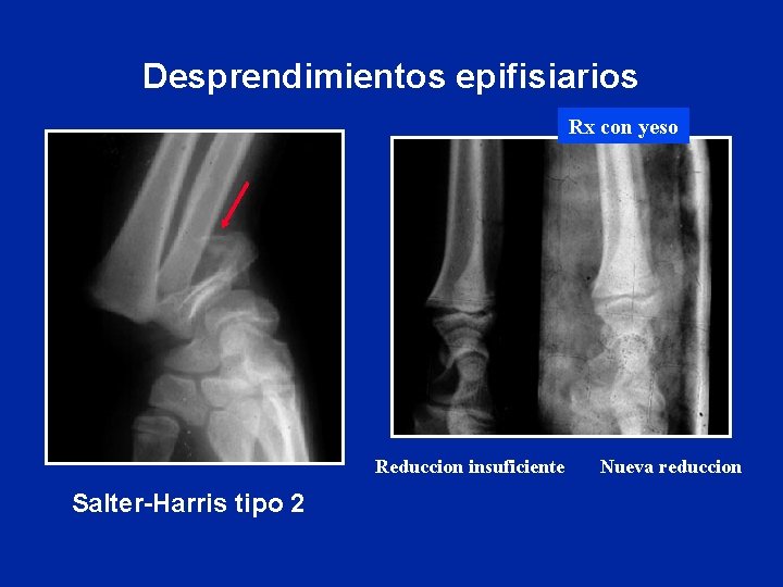 Desprendimientos epifisiarios Rx con yeso Reduccion insuficiente Salter-Harris tipo 2 Nueva reduccion Desprendimientos epifisiarios Rx con yeso Reduccion insuficiente Salter-Harris tipo 2 Nueva reduccion