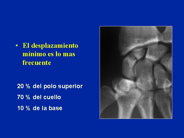 • El desplazamiento mínimo es lo mas frecuente 20 % del polo superior • El desplazamiento mínimo es lo mas frecuente 20 % del polo superior