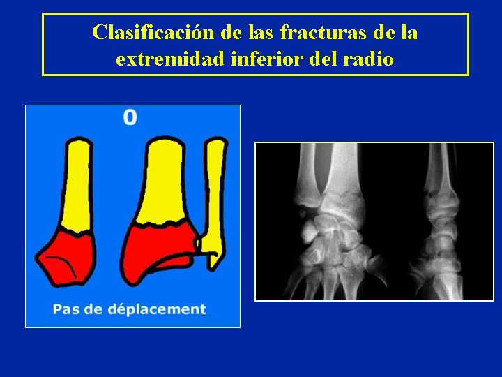 Clasificación de las fracturas de la extremidad inferior del radio Clasificación de las fracturas de la extremidad inferior del radio