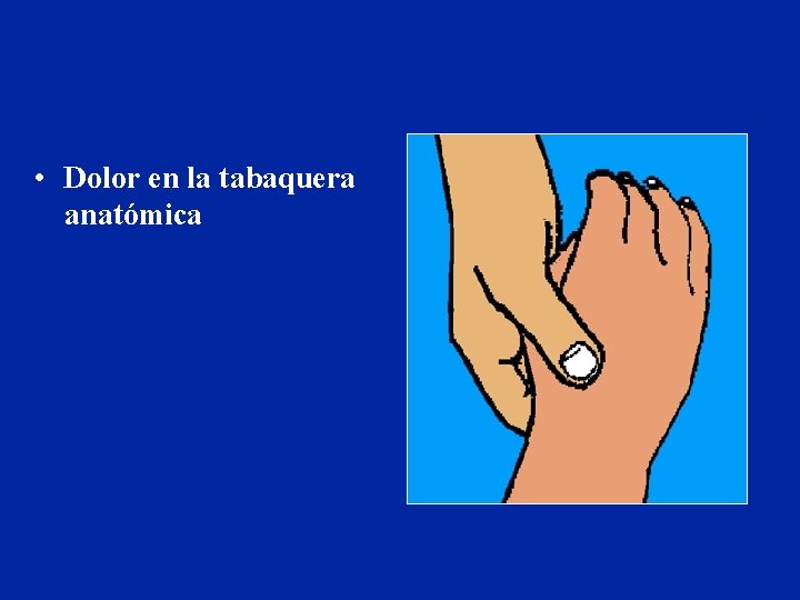 • Dolor en la tabaquera anatómica • Dolor en la tabaquera anatómica