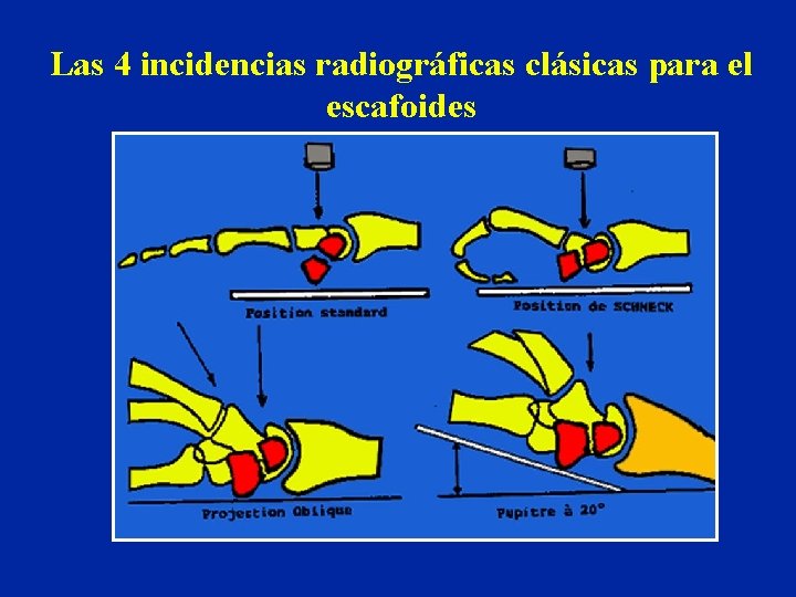 Las 4 incidencias radiográficas clásicas para el escafoides Las 4 incidencias radiográficas clásicas para el escafoides