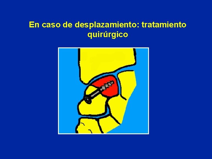 En caso de desplazamiento: tratamiento quirúrgico En caso de desplazamiento: tratamiento quirúrgico