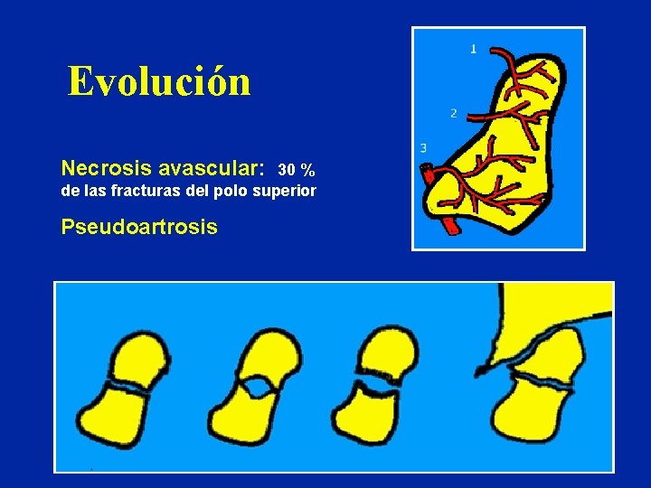 Evolución Necrosis avascular: 30 % de las fracturas del polo superior Pseudoartrosis Evolución Necrosis avascular: 30 % de las fracturas del polo superior Pseudoartrosis